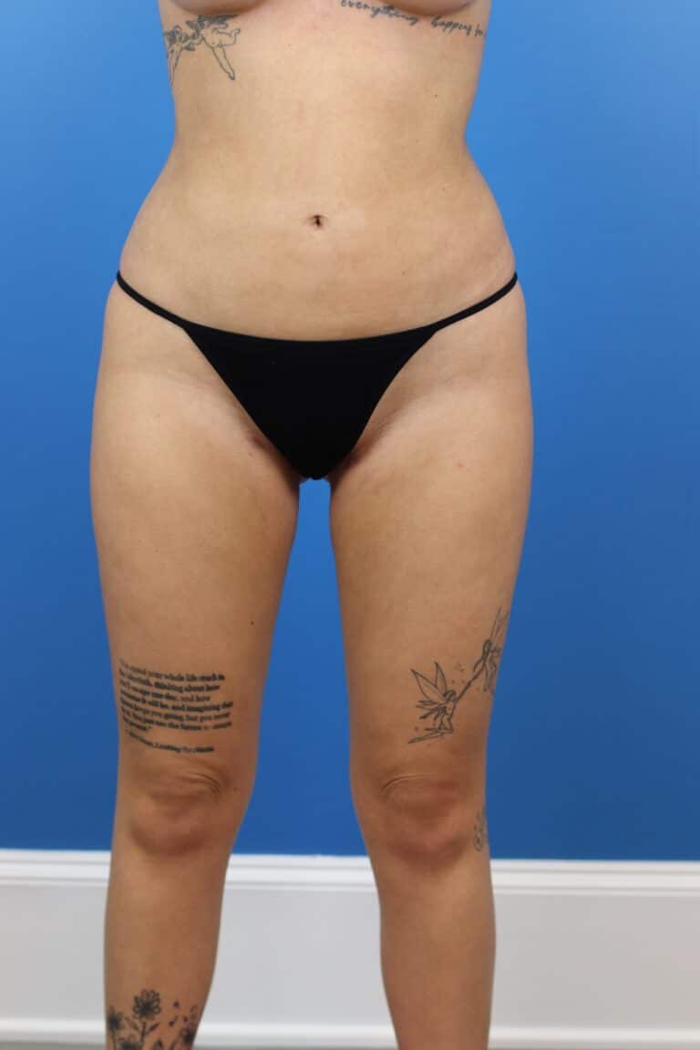 After Image: Autologous Fat Grafting to Breasts - front