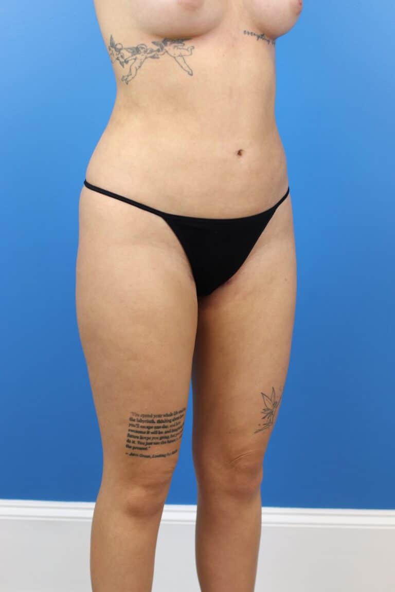 After Image: Autologous Fat Grafting to Breasts - right-front-oblique