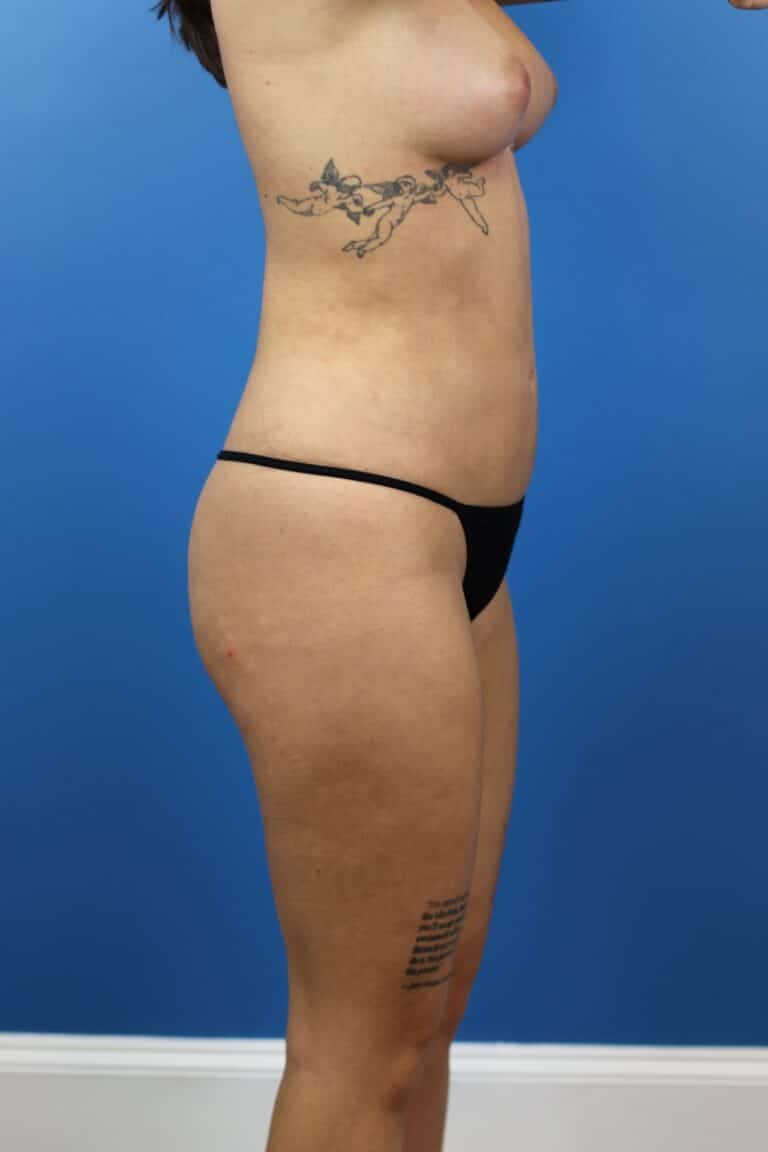 After Image: Autologous Fat Grafting to Breasts - right-side