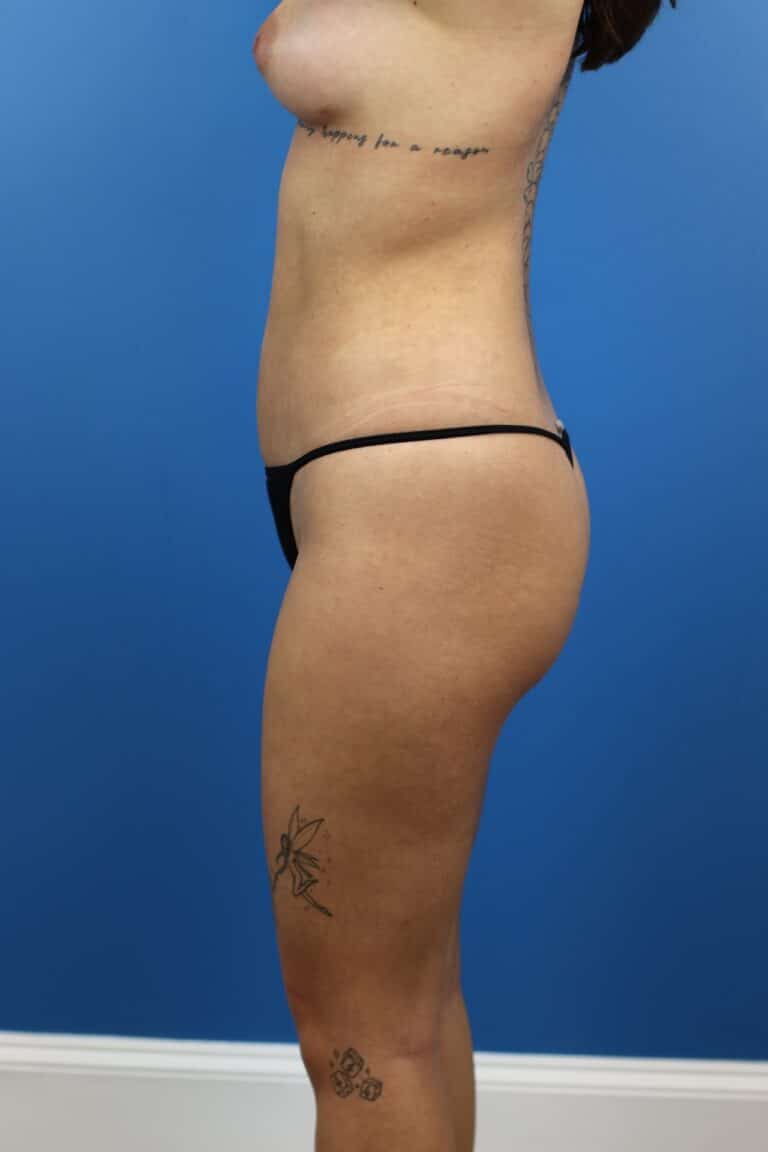 After Image: Autologous Fat Grafting to Breasts - left-side