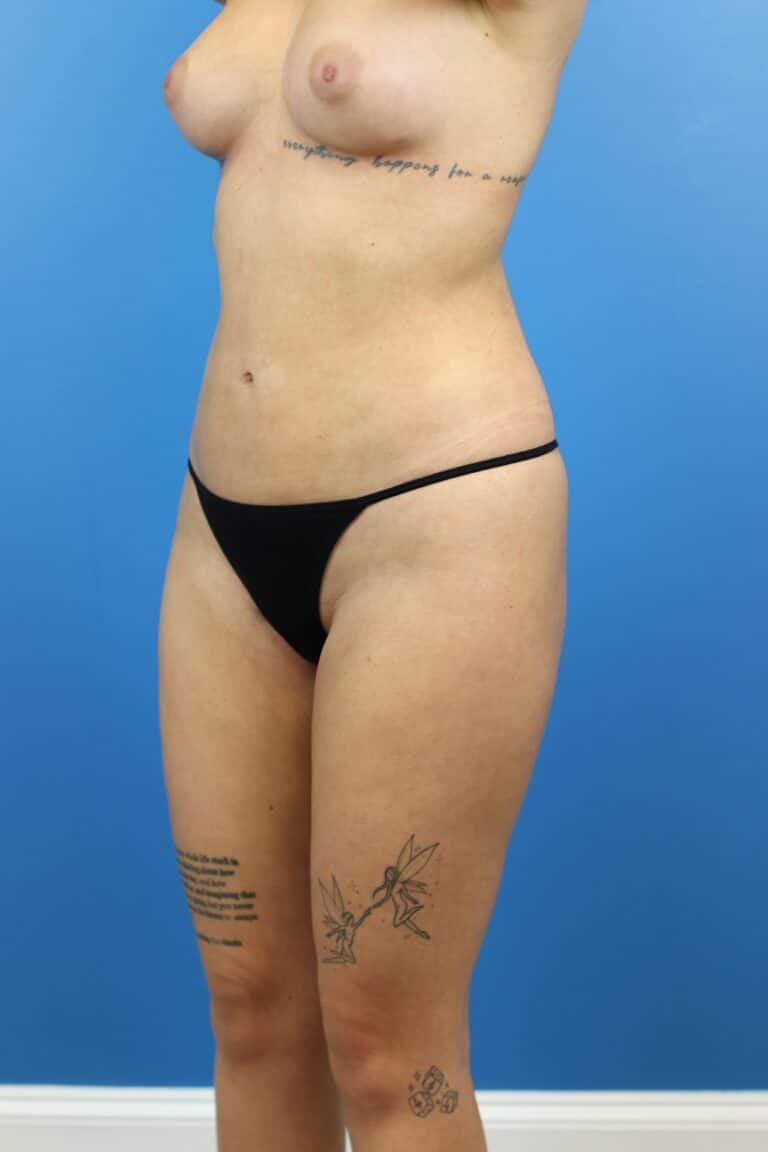 After Image: Autologous Fat Grafting to Breasts - left-front-oblique