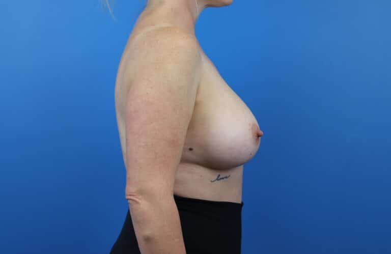 After Image: Breast Augmentation - right-side