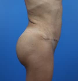 After Image: Brazilian Buttock Lift - right-side