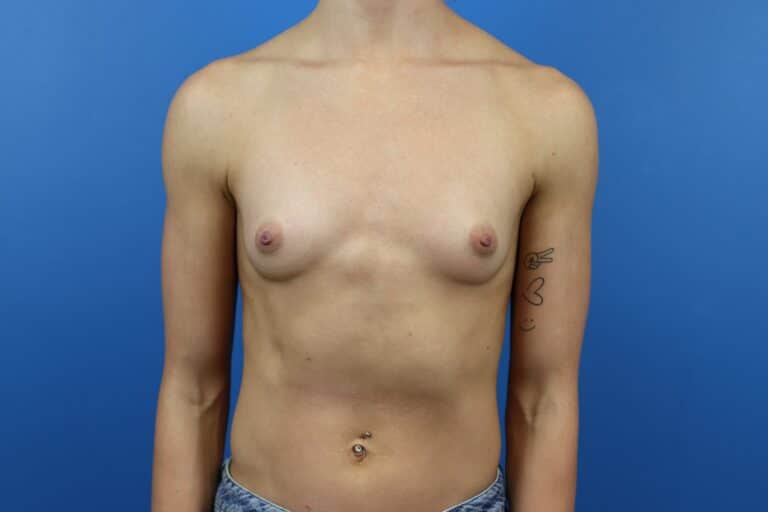 Before Image: Breast Augmentation - front