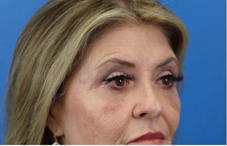 After Image: Blepharoplasty - right-front-oblique