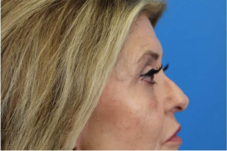 After Image: Blepharoplasty - right-side