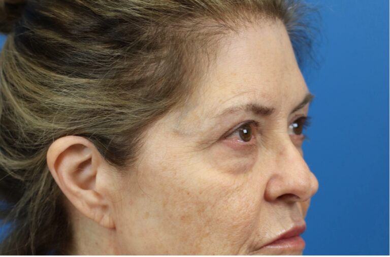 Before Image: Blepharoplasty - right-front-oblique