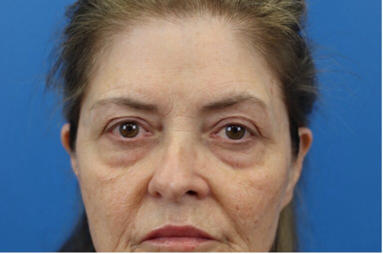 Before Image: Blepharoplasty - front