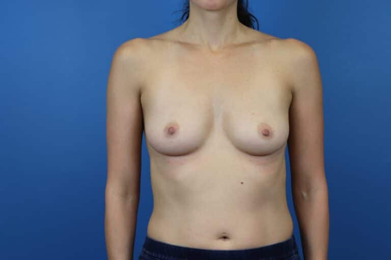 Before Image: Breast Augmentation - front