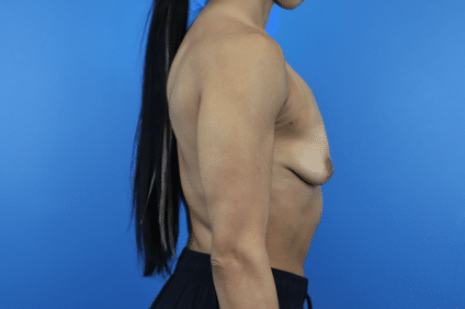 Before Image: Breast Augmentation - right-side