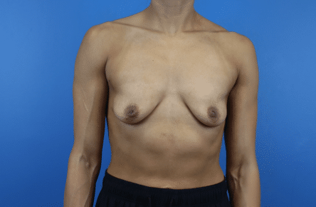 Before Image: Breast Augmentation - front