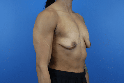 Before Image: Breast Augmentation - right-front-oblique