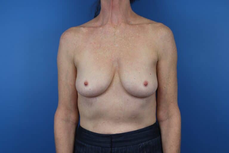 Before Image: Breast Augmentation - front