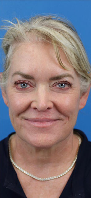 After Image: Junera Subdermal Laser - front