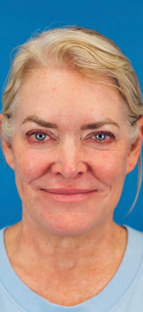 Before Image: Junera Subdermal Laser - front