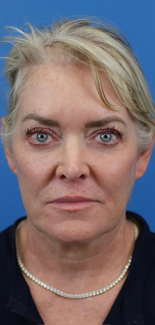 After Image: Junera Subdermal Laser - front