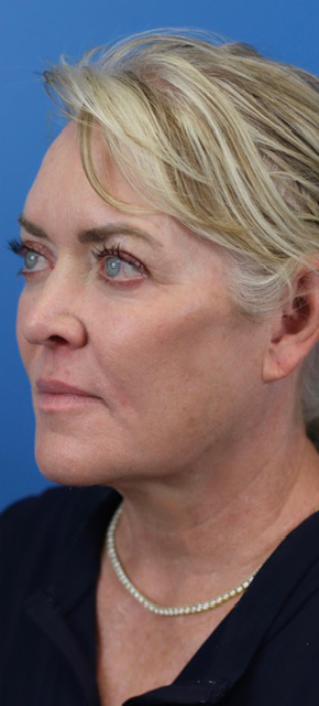 After Image: Junera Subdermal Laser - left-front-oblique