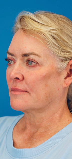 Before Image: Junera Subdermal Laser - left-front-oblique