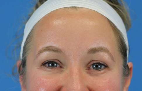 After Image: Junera Subdermal Laser - front