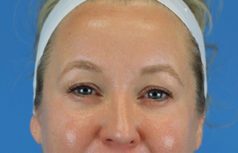 Before Image: Junera Subdermal Laser - front