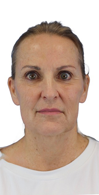 After Image: Junera Subdermal Laser - front