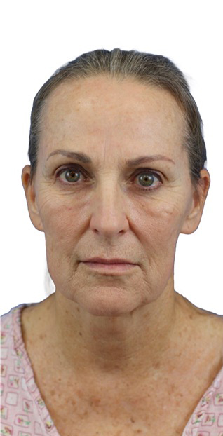 Before Image: Junera Subdermal Laser - front