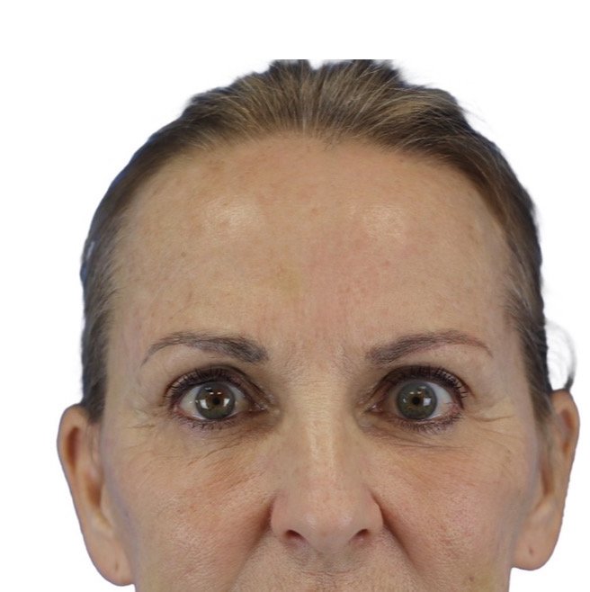After Image: Junera Subdermal Laser - front