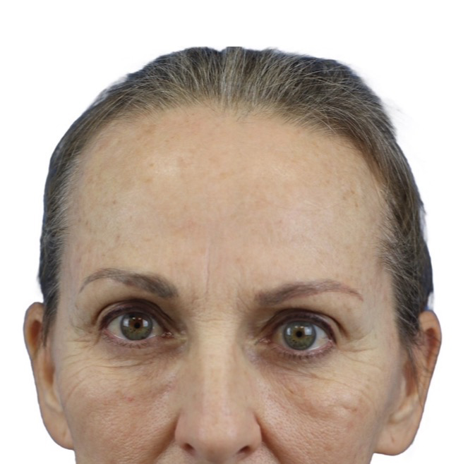 Before Image: Junera Subdermal Laser - front