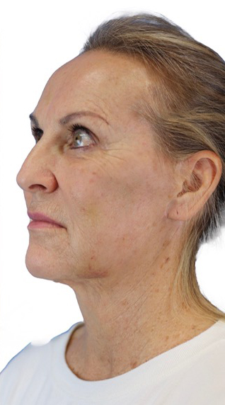 After Image: Junera Subdermal Laser - left-front-oblique