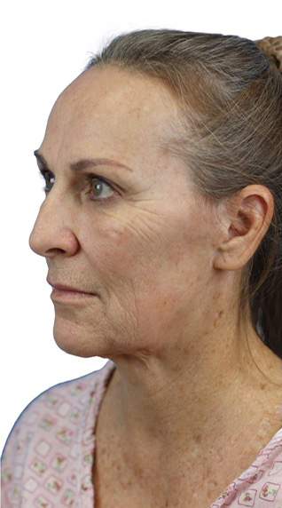 Before Image: Junera Subdermal Laser - left-front-oblique