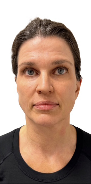 After Image: Junera Subdermal Laser - front