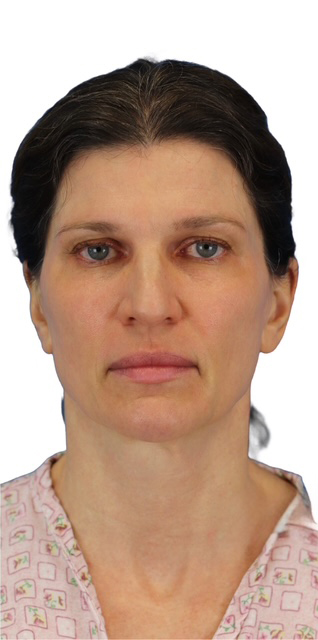 Before Image: Junera Subdermal Laser - front