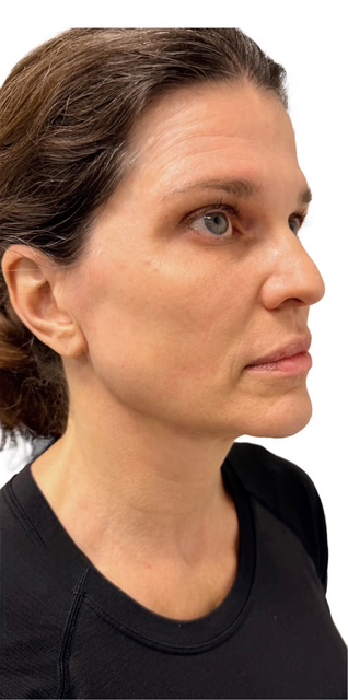 After Image: Junera Subdermal Laser - right-front-oblique