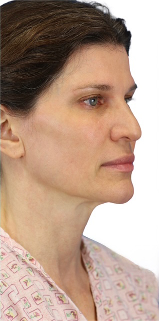 Before Image: Junera Subdermal Laser - right-front-oblique