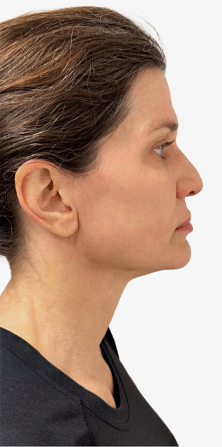 After Image: Junera Subdermal Laser - right-side