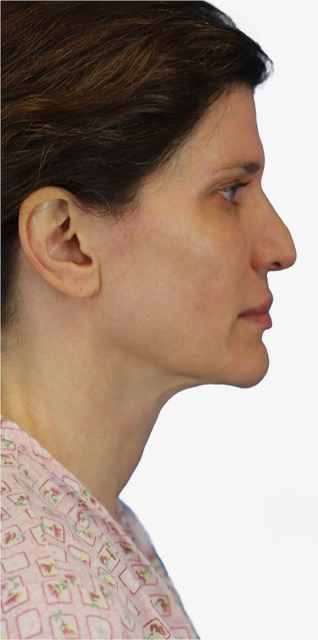 Before Image: Junera Subdermal Laser - right-side