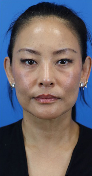 After Image: Junera Subdermal Laser - front