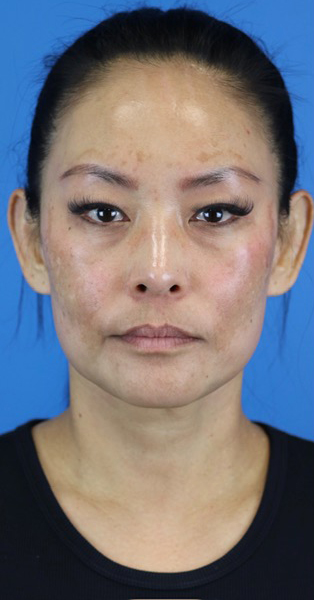 Before Image: Junera Subdermal Laser - front