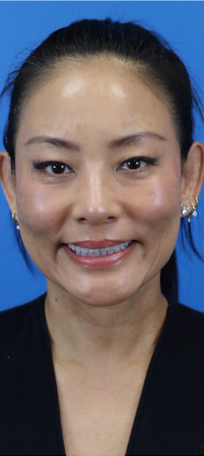 After Image: Junera Subdermal Laser - front