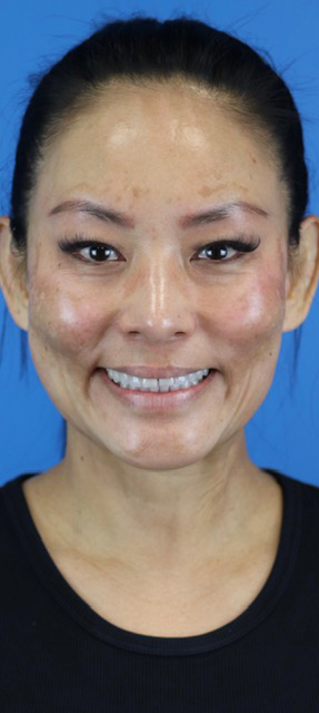 Before Image: Junera Subdermal Laser - front