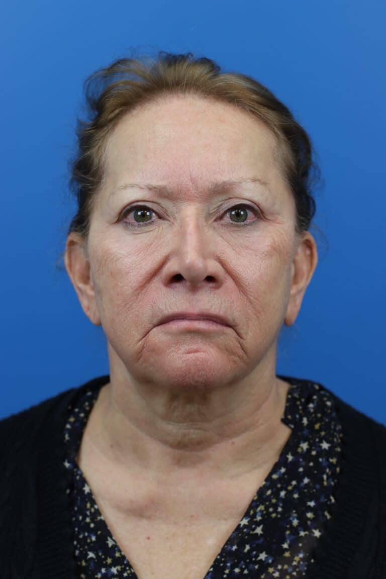 Before Image: Secondary Face/Necklift - front