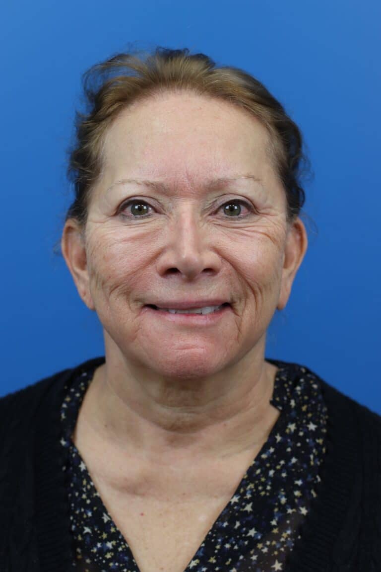 Before Image: Secondary Face/Necklift - front