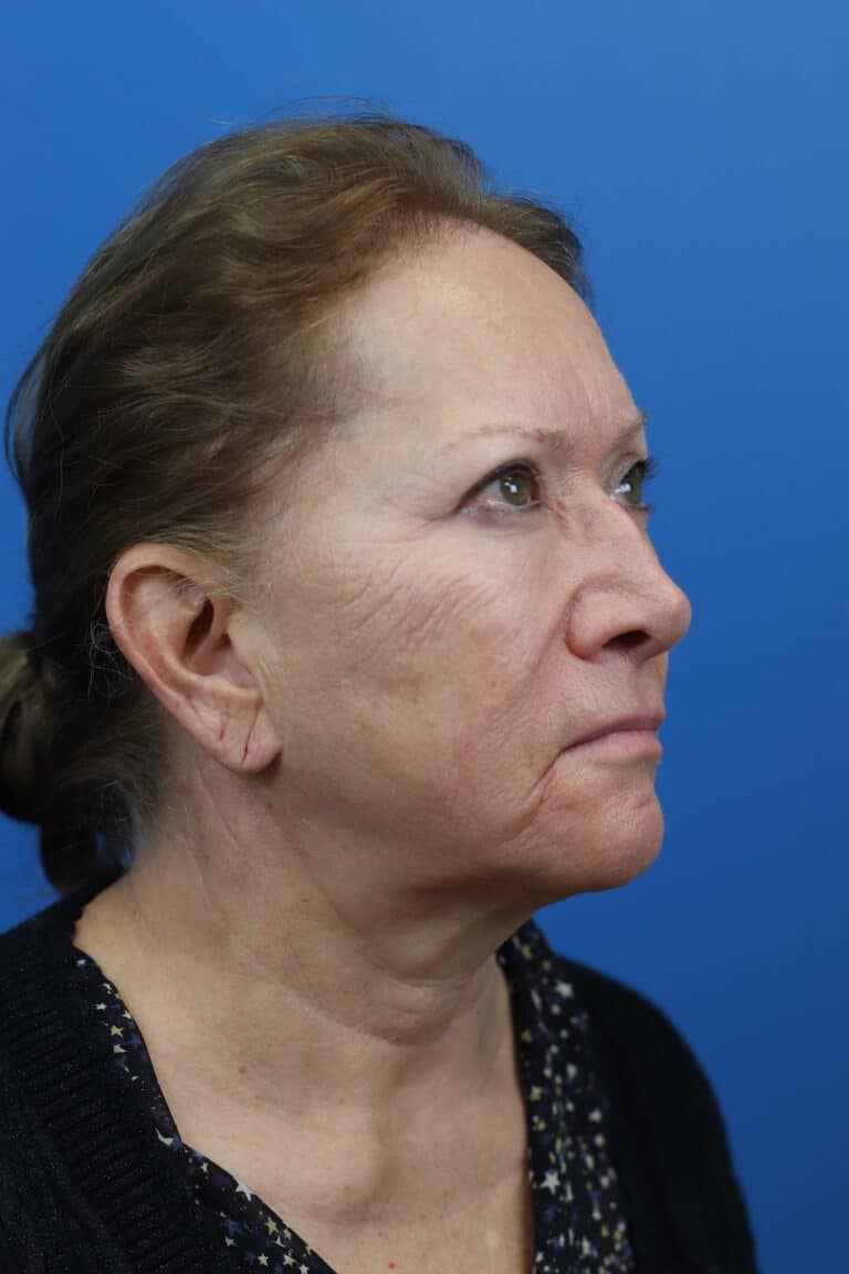 Before Image: Secondary Face/Necklift - right-front-oblique