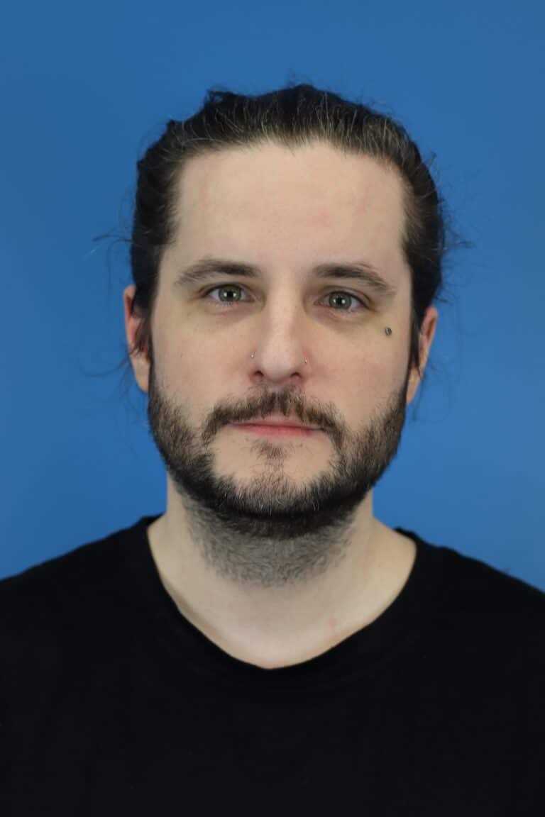 Before Image: Open Septorhinoplasty - front