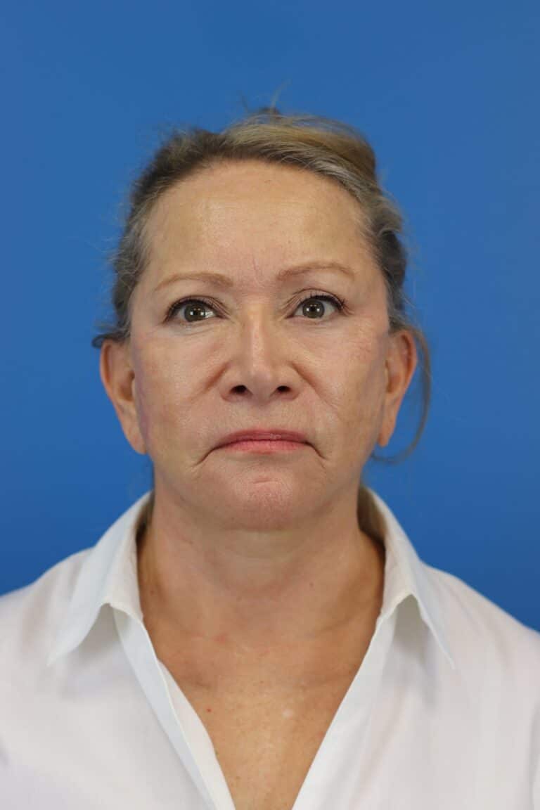 After Image: Secondary Face/Necklift - front