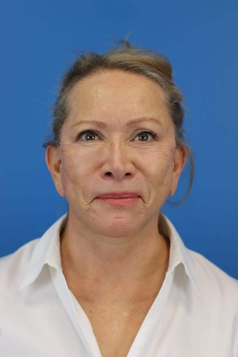 After Image: Secondary Face/Necklift - front