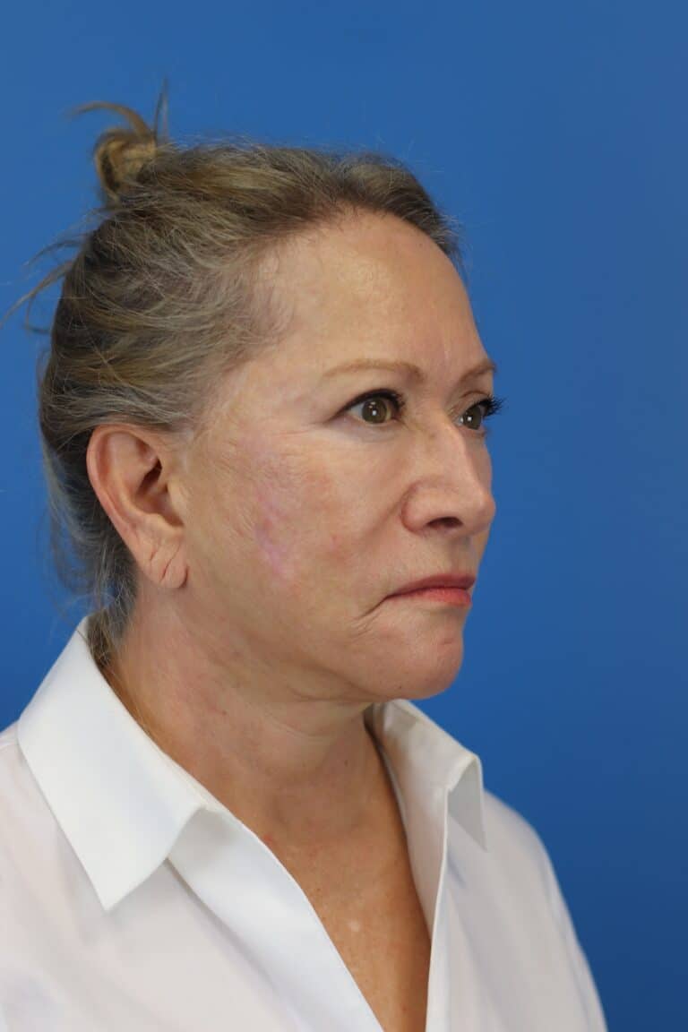After Image: Secondary Face/Necklift - right-front-oblique