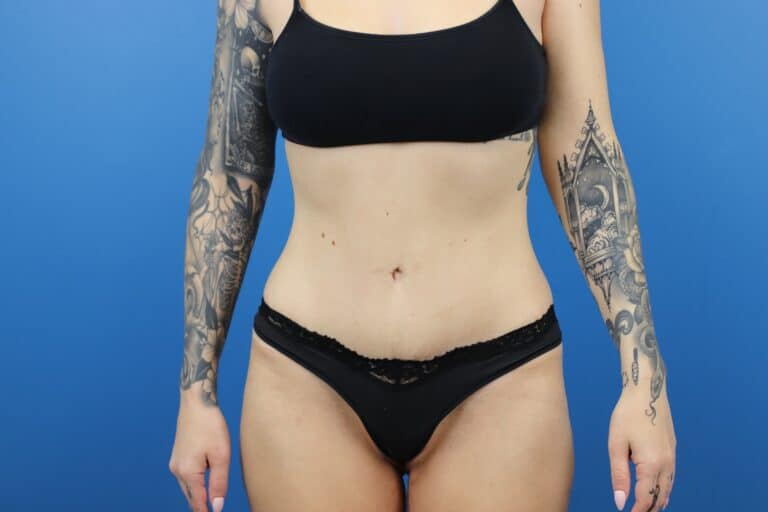 After Image: Abdominoplasty with Liposuction - front