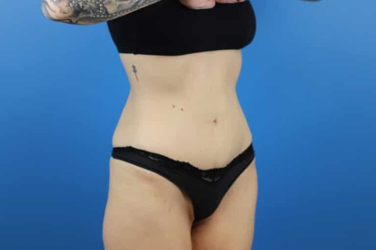 After Image: Abdominoplasty with Liposuction - right-front-oblique