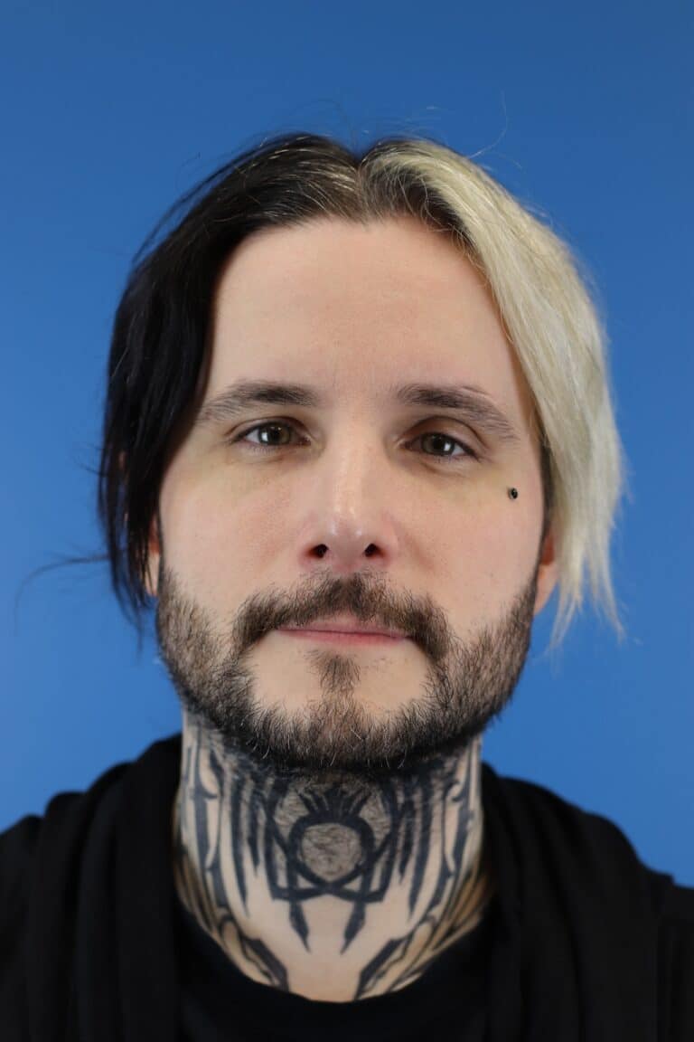 After Image: Open Septorhinoplasty - front